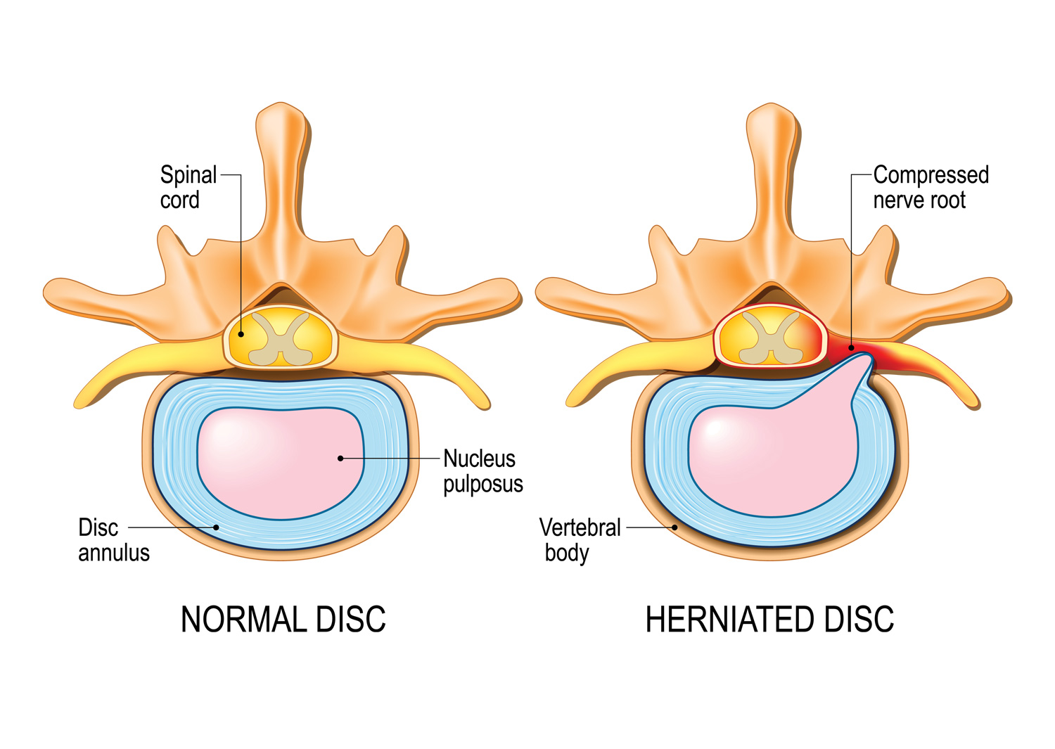 illustration of herniated disc compressing a nerve root 