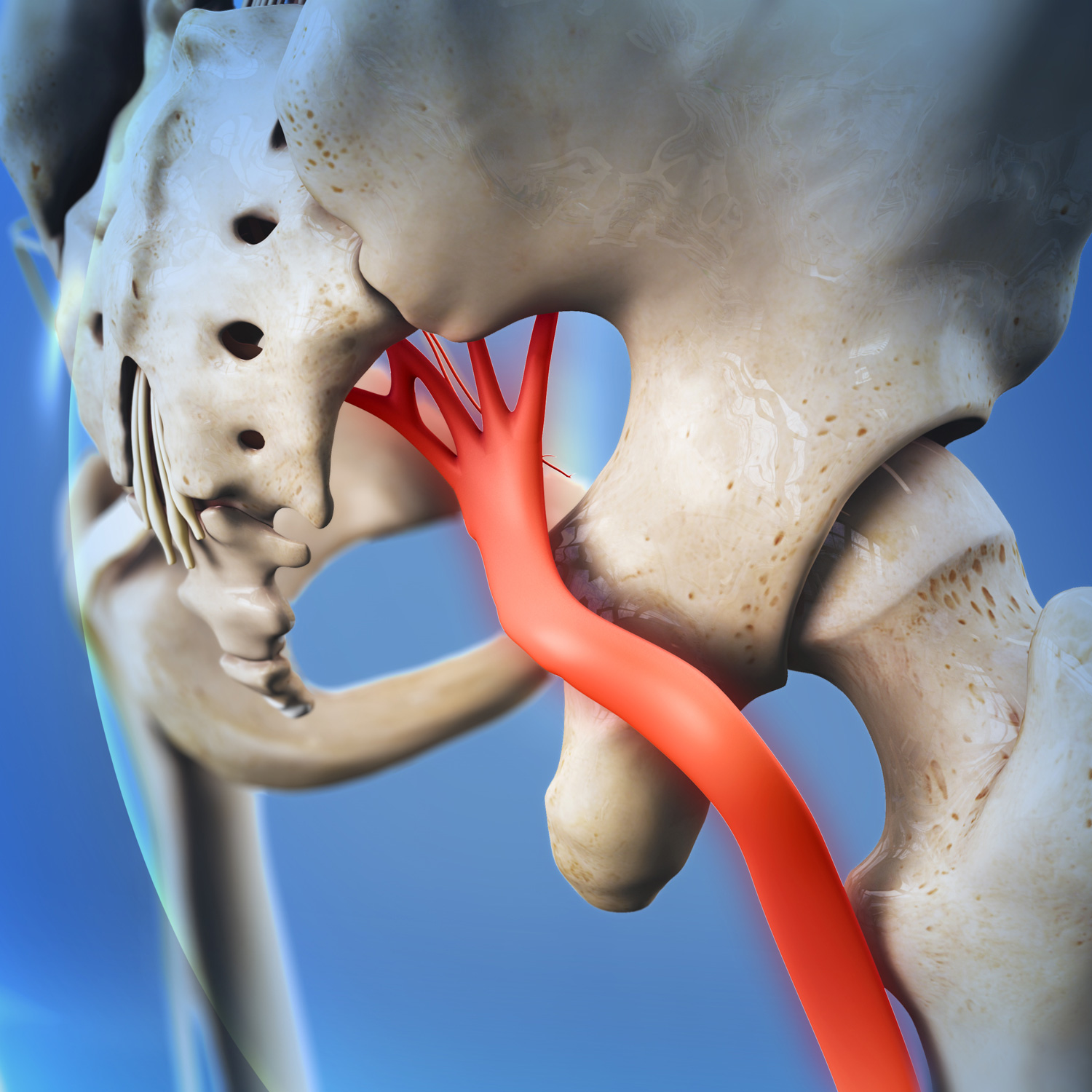 sciatica pain that occurs when the nerve is compressed or irritated
