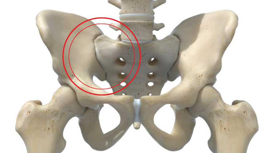 Image of Pelvis and inflamed SI Joint